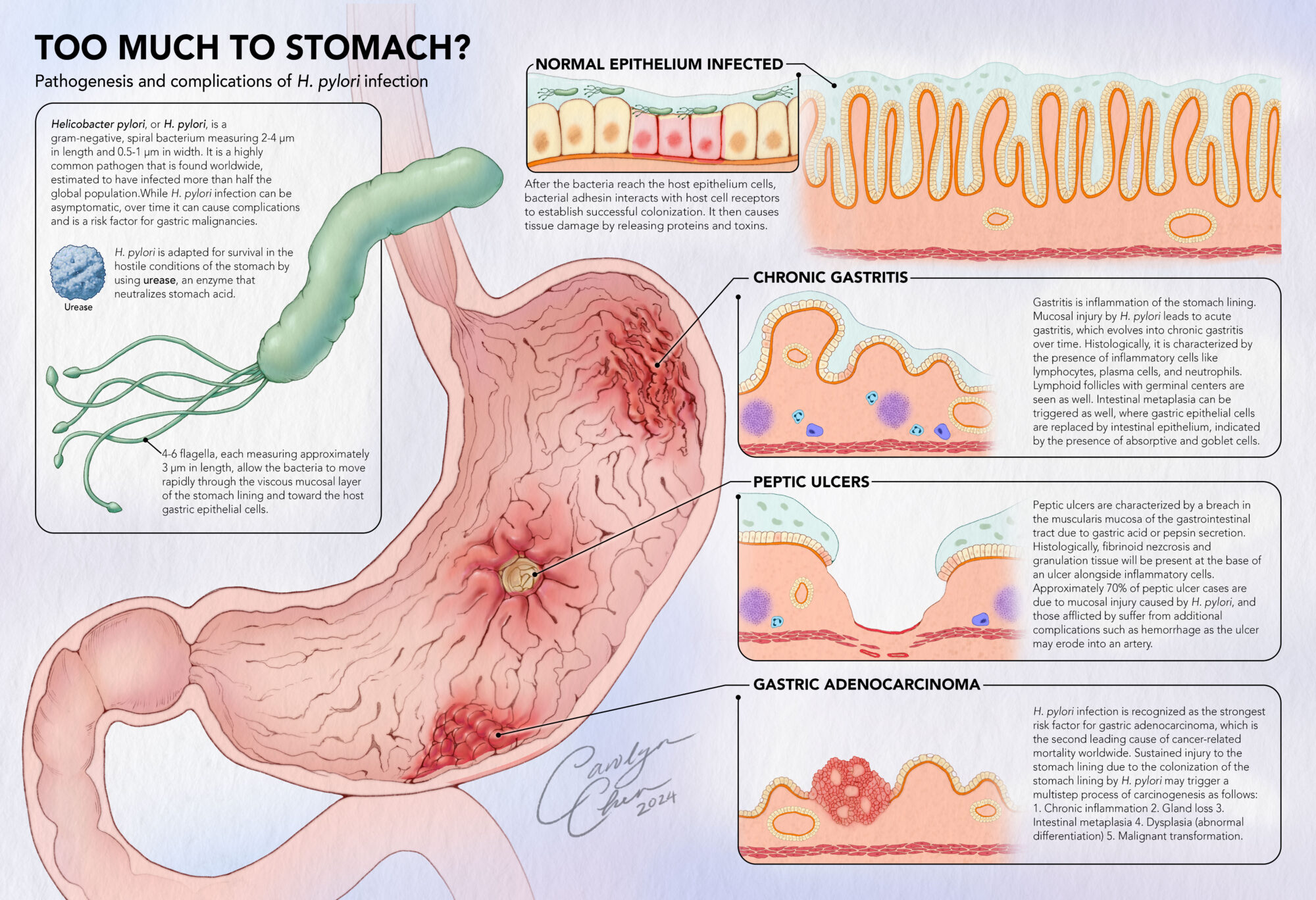 Pathogenesis and Complications of H. pylori – Carolyn Chen Biomedical ...
